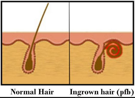 Razor Bumps Marque Urgent Care
